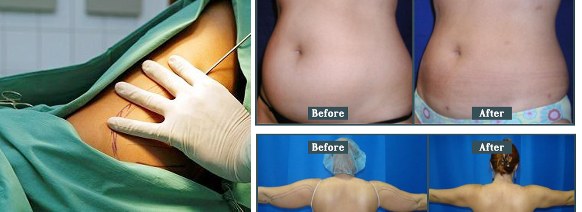 980 clinical lipolysis.png