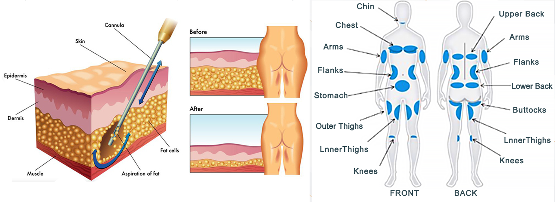 980 theory lipolysis.png